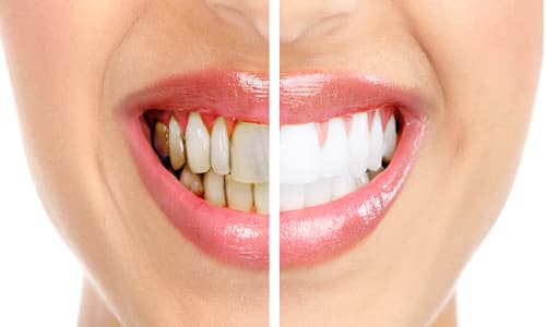 طرق علاج تسوس الأسنان الأمامية