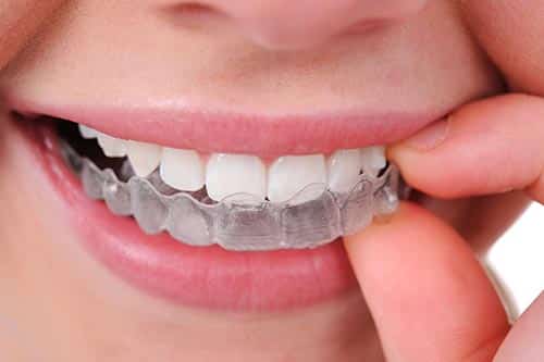 أبرز مميزات وعيوب التقويم الشفاف للأسنان
