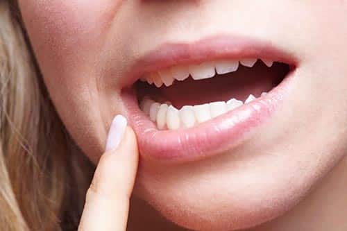 أهم الطرق لمعالجة إلتهابات اللثة