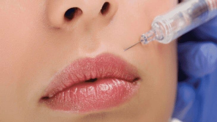 أضرار نفخ الشفاه