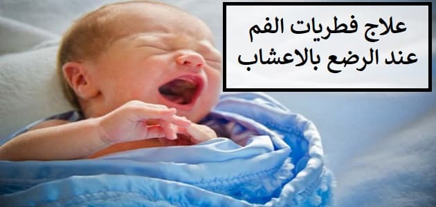 علاج فطريات الفم عند الرضع بالاعشاب