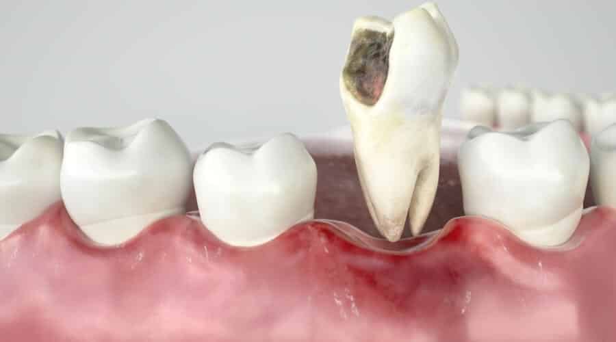 اضرار خلع الضرس وبه خراج