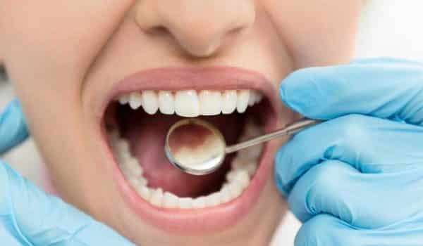 علاج تسوس الأسنان الأمامية في المنزل بسهولة